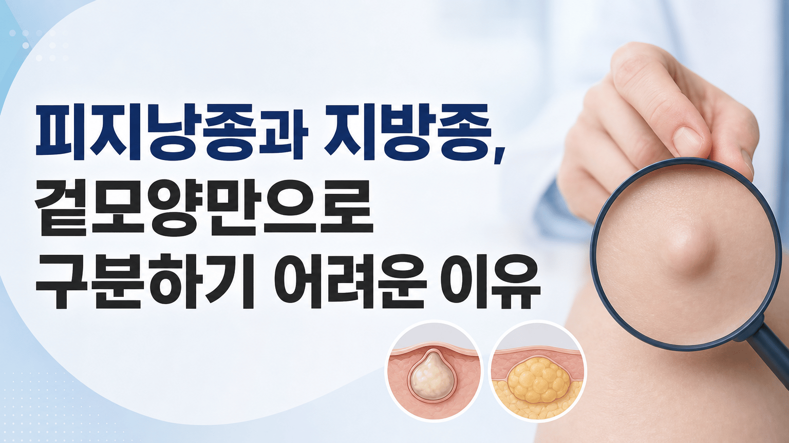 피지낭종과 지방종, 겉모양만으로 구분하기 어려운 이유