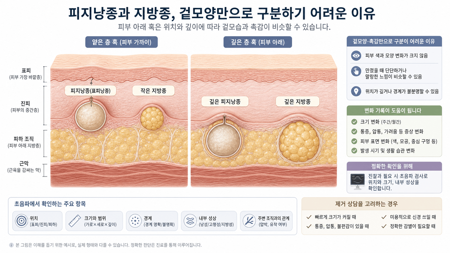피지낭종과 지방종, 겉모양만으로 구분하기 어려운 이유